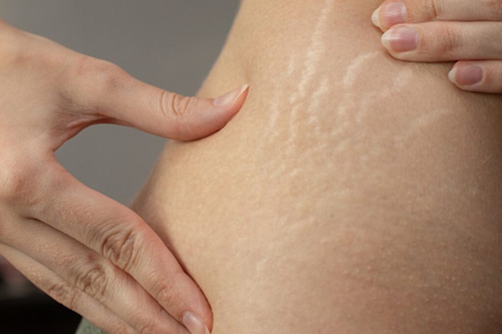 Natural Ingredients' Potential to Remove Stretch Marks